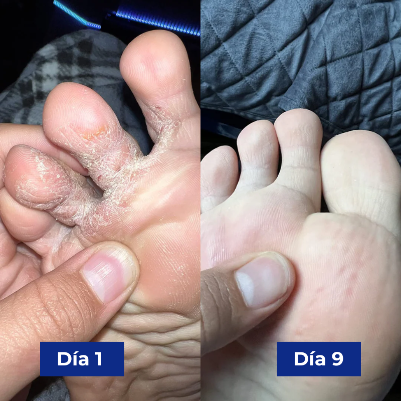 Reboot Labs™ Spray antimicótico para el pie de atleta