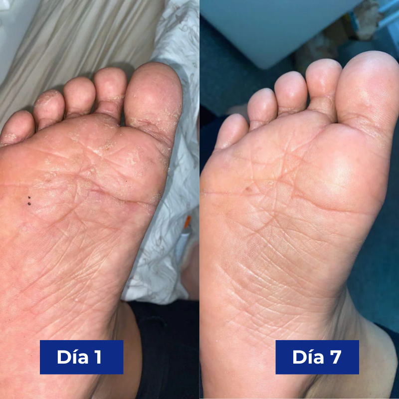 Reboot Labs™ Spray antimicótico para el pie de atleta