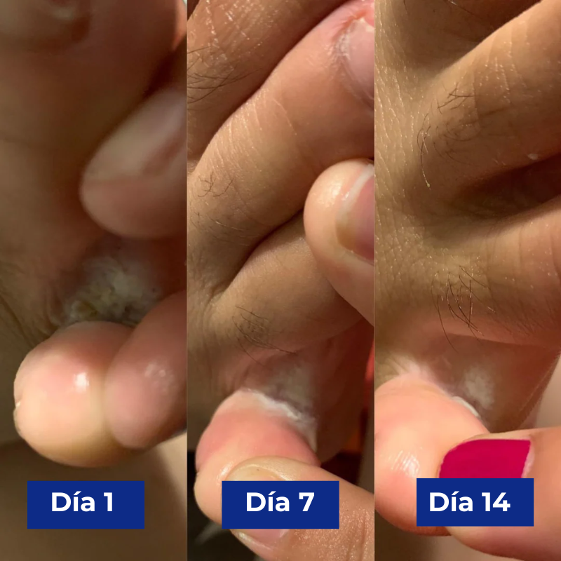 Reboot Labs™ Spray antimicótico para el pie de atleta